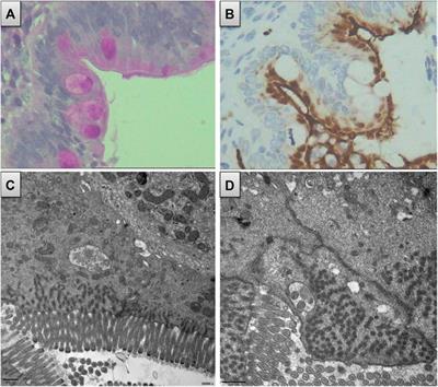 Case Report: MYO5B Homozygous Variant c.2090+3A>T Causes Intron Retention Related to Chronic Cholestasis and Diarrhea